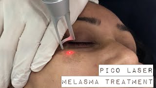 Melasma treatment with PICO Laser [upl. by Ssej]