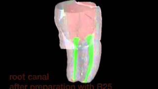 VDW Dental · MicroCTScan of a lower molar clinical video [upl. by Koziara499]