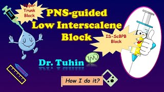 PNS guided Low Approach Interscalene Block  Upper Trunk Block  Brachial Plexus Block  Landmark [upl. by Anaik]