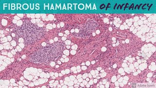 Fibrous Hamartoma of Infancy [upl. by Kolnos]