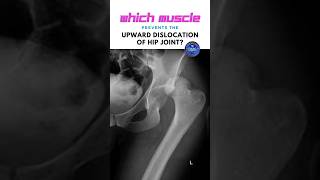 Which muscle prevents the upward dislocation of hip joint Hip joint dislocation shorts [upl. by Sirovaj]