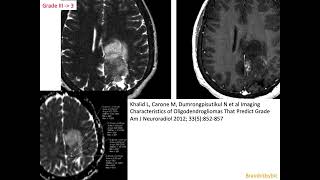 63 Oligodendroglioma 1p19q codeleted IDHmutant corticalsubcortical mass oligoastrocytoma [upl. by Nnylrebma]