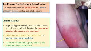 Type III – Hypersensitivity Reactions Part 3 [upl. by Klingel]