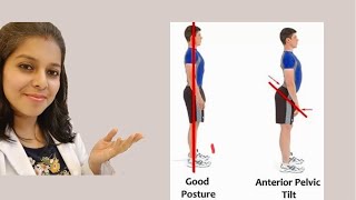 Anterior Pelvic Tilt [upl. by Atteyram]