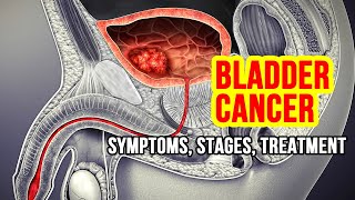 Bladder Cancer Explained Symptoms Risk Factors and Treatment Options [upl. by Noisla527]