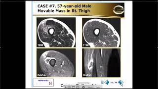 MRI of the Muscles Lectures  Part 2 [upl. by Amyas]