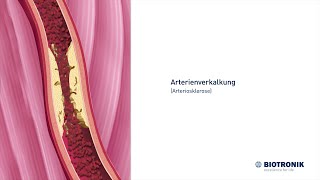 Arterienverkalkung Arteriosklerose und Angiografie [upl. by Aihsenat]