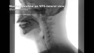 Normal Swallowing on Lateral View Videofluoroscopy Krishnakumar Thankappan [upl. by Dunson]