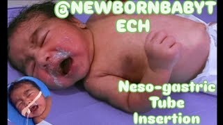 Nesogastric NG tube Insertion in neonatenewborn orogastric OG tube neonate feeding tube [upl. by Hodges936]