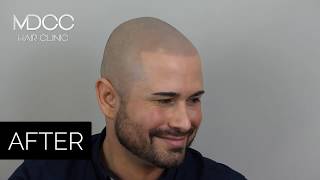 Scalp Micropigmentation in Kent  South east England [upl. by London]