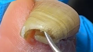 Extremely long ingrown toenailsThe patient has not had a pedicure for 4 months【Xue Yidao】 [upl. by Ela]