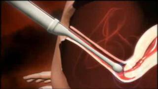 3D animation of how IVF works [upl. by Demp449]