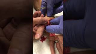 3 inch splinter removal [upl. by Brogle]