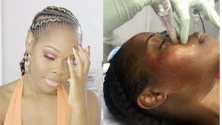 Microneedling Before and After on Dark Skin  GRWM [upl. by Britte]