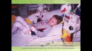 Epidermolysis Bullosa EB Awareness video extended [upl. by Roanna456]