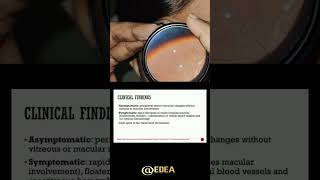 Retinal vasculitis viralvideo trending science eyes eyedea [upl. by Niwhsa]