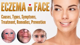 Eczema on Face Causes Symptoms Types Treatment Natural Home Remedies Prevent  Face Dermatitis [upl. by Len173]