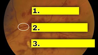 What is Hypertensive Retinopathy [upl. by Editha621]