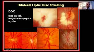 Approach to the Patient with Bilateral Optic Disc Swelling [upl. by Shantee907]