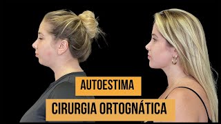 Transformação da face  Cirurgia Ortognática [upl. by Bender535]