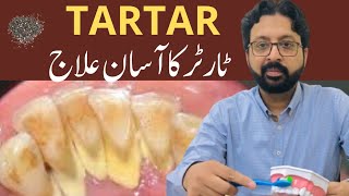 How to Remove TARTAR from Teeth at Home Naturally [upl. by Siocnarf]