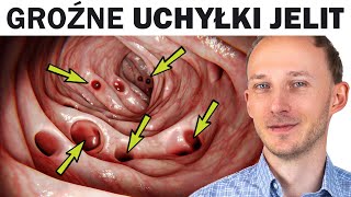 Choruje na to coraz więcej ludzi UCHYŁKI JELIT i jak im zapobiec [upl. by Esdnyl]