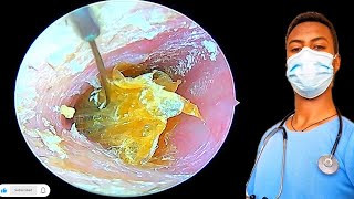 🔴Cleaning of fungi affected ear earearwax earwaxremovalearwaxcleaningrelax [upl. by Aisetal]