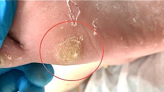 Callus removal from feetampFoot scraping dead skin【Xiao Yan pedicure】stress 718 [upl. by Chere]