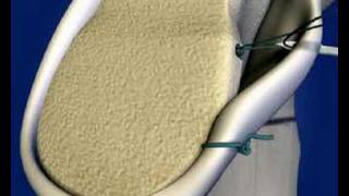 Shoulder Labral Repair [upl. by Medina]