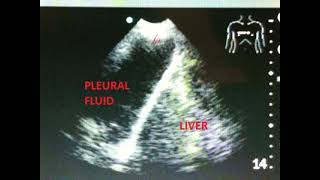 hoovers sign in copd due to increasing intrathoracic negative pressure [upl. by Odom]