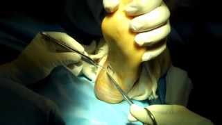 Plantar Fasciotomy [upl. by Loella]