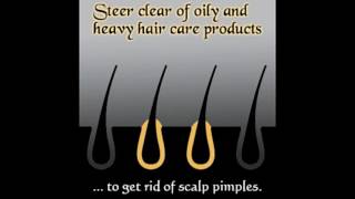 Pimples on the Scalp Causes and Treatment [upl. by Pears770]