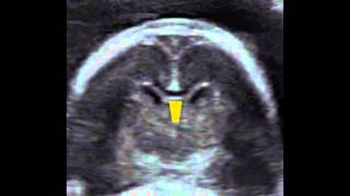 ISUOG How to image the fetal corpus callosum the coronal to median plane approach [upl. by Nossyla]