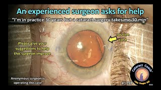 CataractCoach™1797 an experienced surgeon asks for help [upl. by Tiemroth]