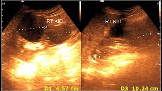 Renal cortical cyst  Milk of calcium cyst  Renal calcification [upl. by Aiker]