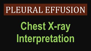 Pleural Effusion  Chest Xray Interpretation [upl. by Ratcliff]