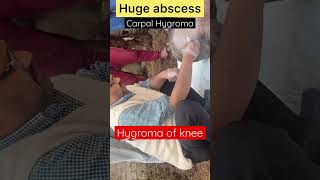 Hygroma of knee l carpal Hygroma l Dr Umar Khan [upl. by Eaver]