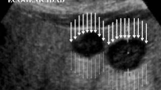 01 Ecografía Hepatobiliopancreática Fundamentos Básicos [upl. by Duston]