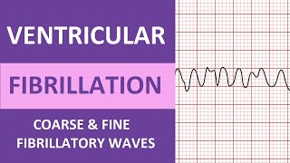 Ventricular Fibrillation VFib ECG Interpretation Nursing Heart Rhythms NCLEX ACLS [upl. by Marcoux754]