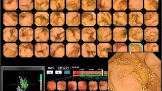 WEO Video Capsule Endoscopy VCE Library clinical case 55 [upl. by Enert245]