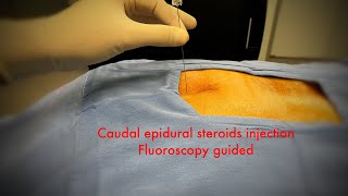 caudal epidural steroids injection fluoroscopystep by step [upl. by Wycoff]