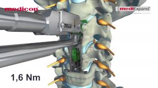 MEDICON  quotmediExpand®quot Cervical [upl. by Ennahs]