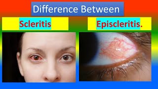 Difference between Scleritis and Episcleritis [upl. by Ellerrad957]