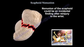 Scaphoid Nonunion  Everything You Need To Know  Dr Nabil Ebraheim [upl. by Eneroc]