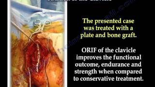 Clavicle fracture fixation  Everything You Need To Know  Dr Nabil Ebraheim [upl. by Eux]