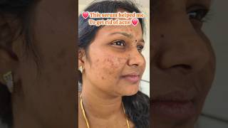 How to get rid of acne acne acneproneskin skincare skincareroutine [upl. by Rickey204]