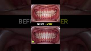 Underbite Braces evolution braces orthodontist dentist [upl. by Oigaib976]