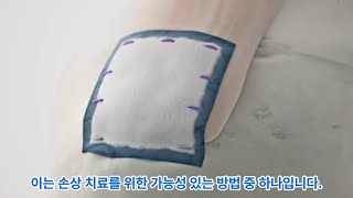 Bioinductive Regeneten Patch Revolutionizing Rotator Cuff Repair 생체유도 Regeneten 패치 회전근개 치료의 혁신 [upl. by Fernandez]