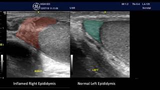 Acute Epididymitis  PointofCare Ultrasound [upl. by Nelrah]