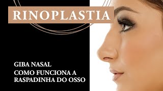 Rinoplastia Giba Nasal como funciona a quotraspadinhaquot do osso  Dr Fábio Maniglia [upl. by Omrellig]